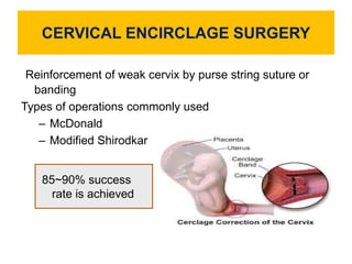 CERVICAL ENCIRCLAGE SURGERY
Reinforcement of weak cervix by purse string suture or
banding
Types of operations commonly used
– McDonald
– Modified Shirodkar
85~90% success
rate is achieved
 