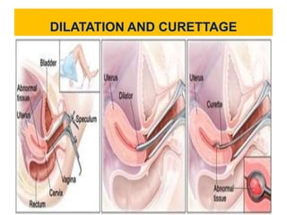 DILATATION AND CURETTAGE
 