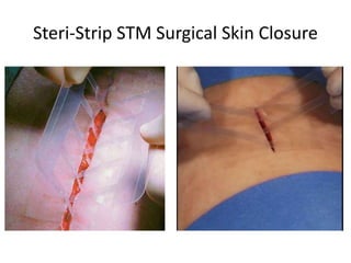 Steri-Strip STM Surgical Skin Closure
 