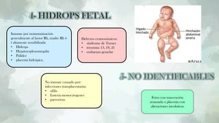 Fetos con maceración
avanzada o placenta con
alteraciones involutivas
Inmune por isoinmunización
generalmente al factor Rh, madre Rh (-
) altamente sensibilizada
• Hidrops
• Hepatoesplenomegalia
• Palidez
• placenta hidrópica.
No inmune causado por:
infecciones transplacentarias
• sífilis
• Listeria monocytogenes
• parvovirus
Defectos cromosómicos:
• síndrome de Turner
• trisomías 13, 18, 21
• embarazo gemelar
 