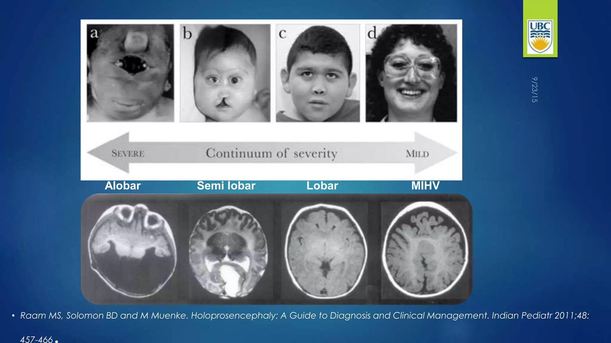 Holoprosencephaly PPTX