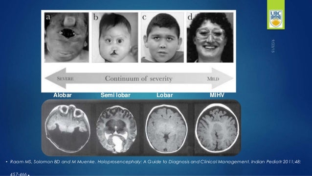 Severity - Severe Brain Damage Severity - Severe Brain Damage