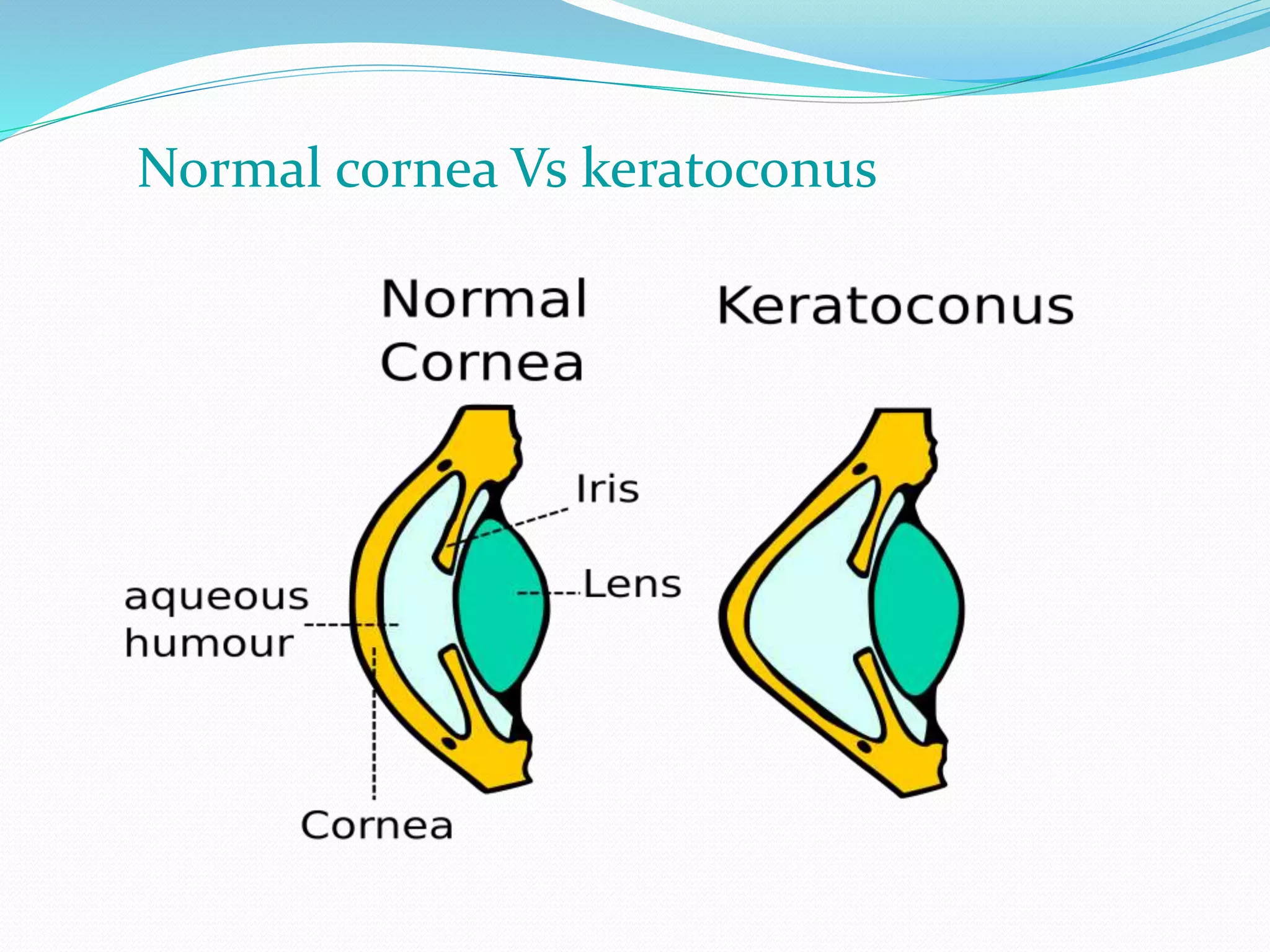 Normal cornea Vs keratoconus
 