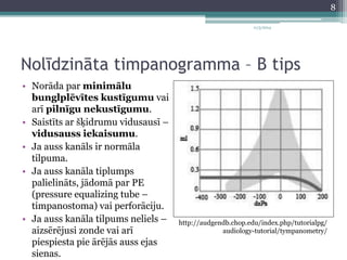 11/3/2014 
Nolīdzināta timpanogramma – B tips 
• Norāda par minimālu 
bunglplēvītes kustīgumu vai 
arī pilnīgu nekustīgumu. 
• Saistīts ar šķidrumu vidusausī – 
vidusauss iekaisumu. 
• Ja auss kanāls ir normāla 
tilpuma. 
• Ja auss kanāla tiplumps 
palielināts, jādomā par PE 
(pressure equalizing tube – 
timpanostoma) vai perforāciju. 
• Ja auss kanāla tilpums neliels – 
aizsērējusi zonde vai arī 
piespiesta pie ārējās auss ejas 
sienas. 
http://audgendb.chop.edu/index.php/tutorialpg/ 
audiology-tutorial/tympanometry/ 
8 
 