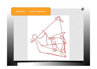 Dentición - Incisivo Superior.
 