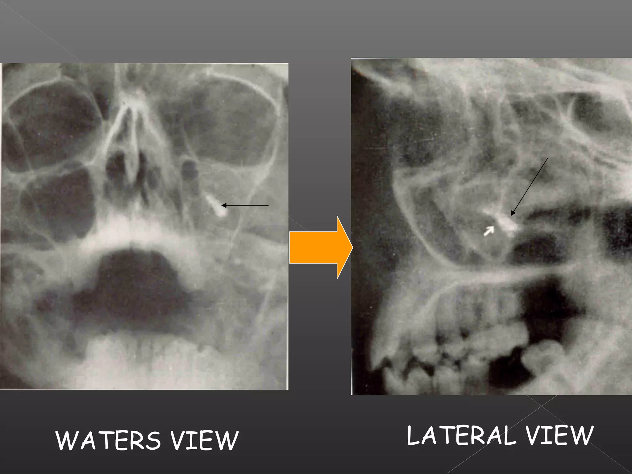 WATERS VIEW LATERAL VIEW 
 