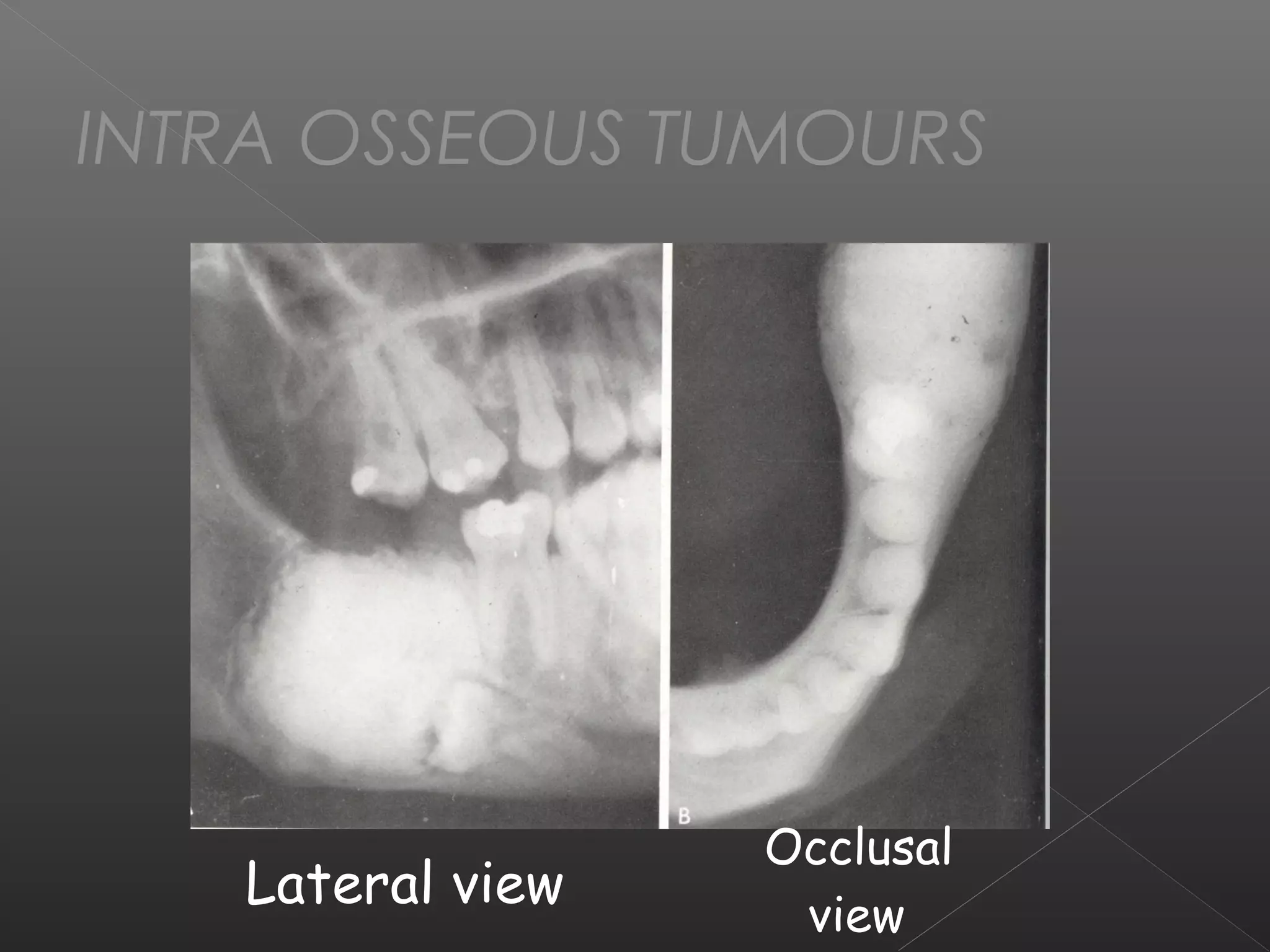 INTRA OSSEOUS TUMOURS 
Occlusal 
Lateral view view 
 