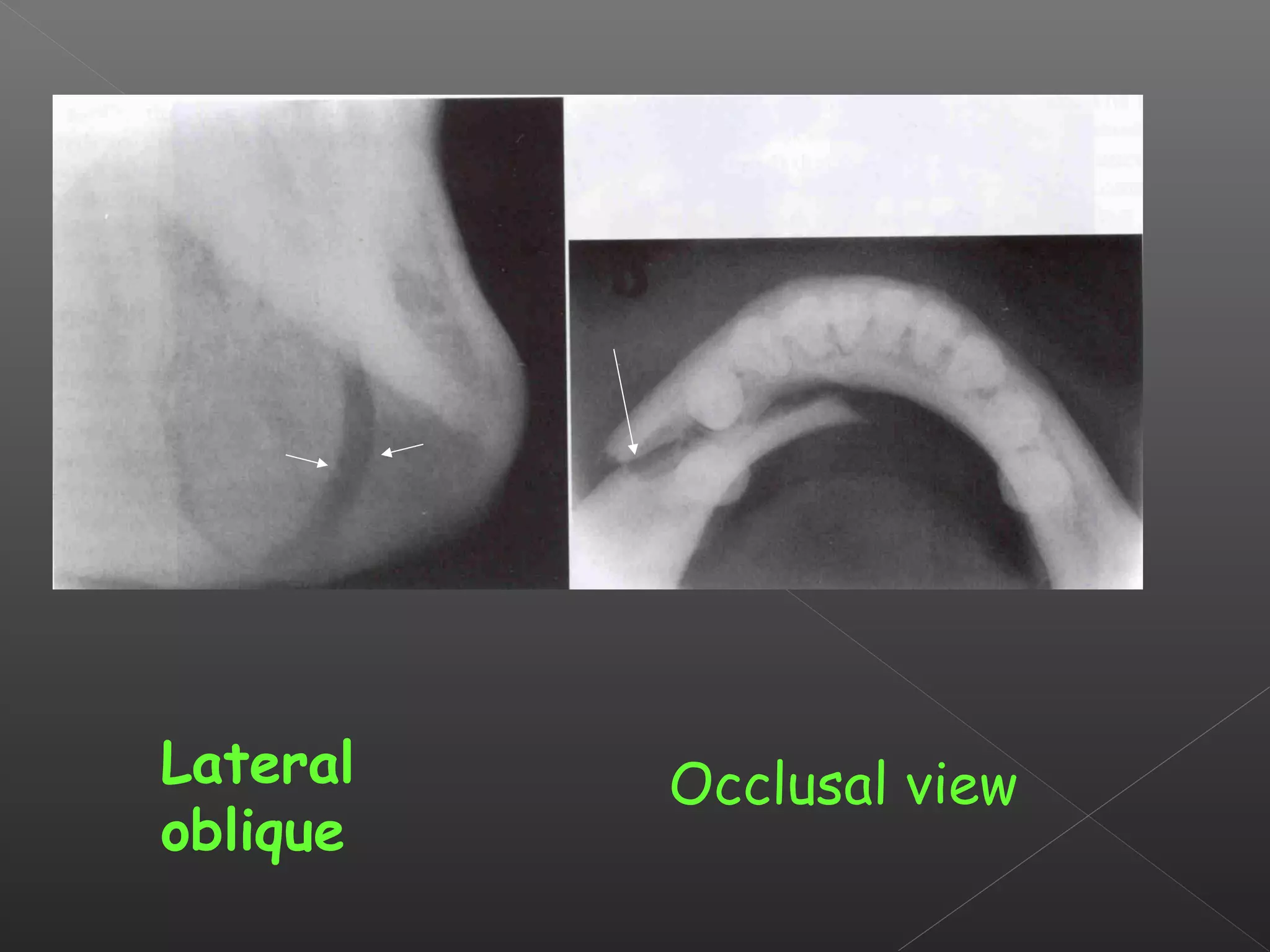 Lateral 
oblique 
Occlusal view 
 
