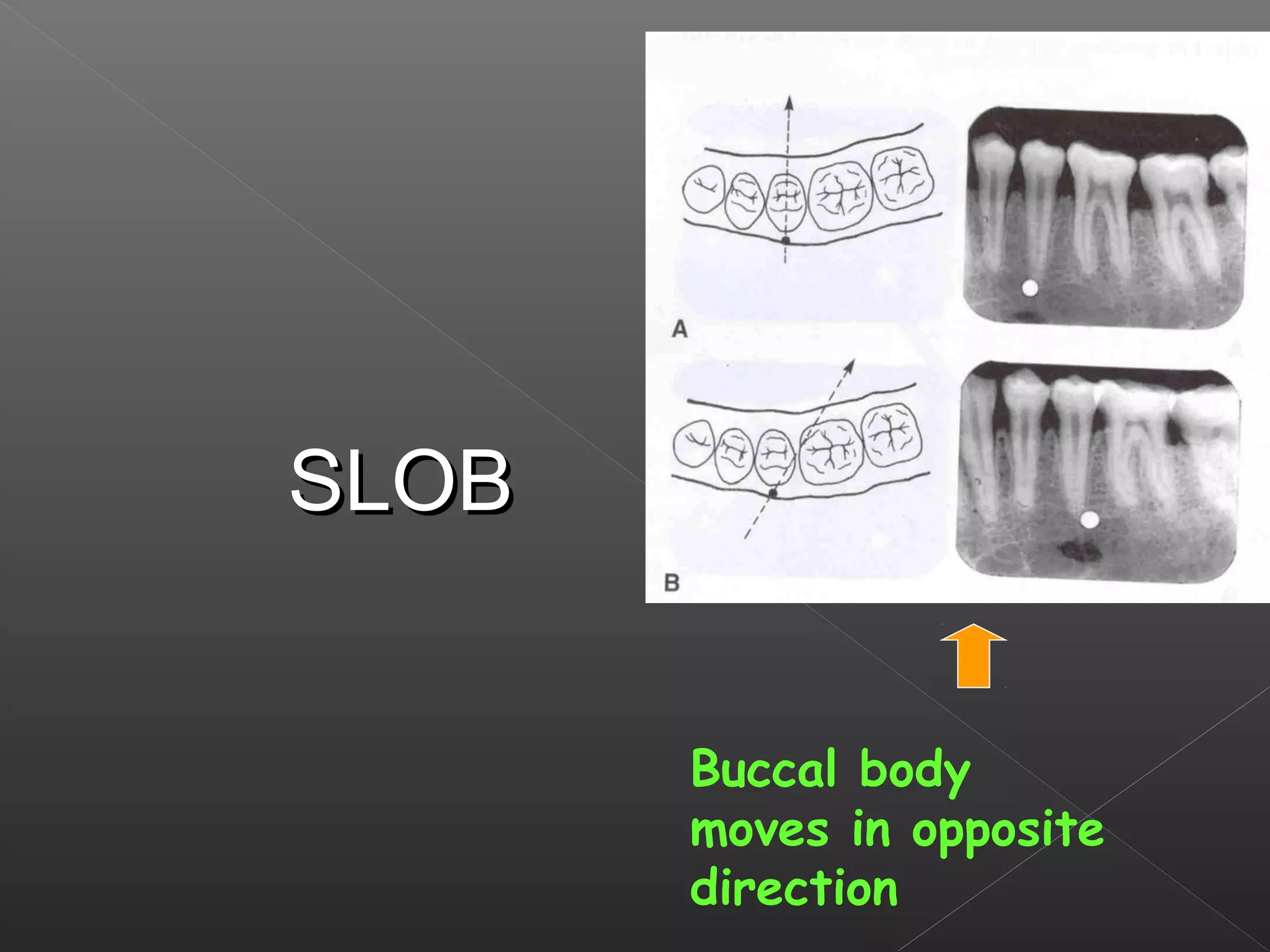 Buccal body 
moves in opposite 
direction 
SSLLOOBB 
 