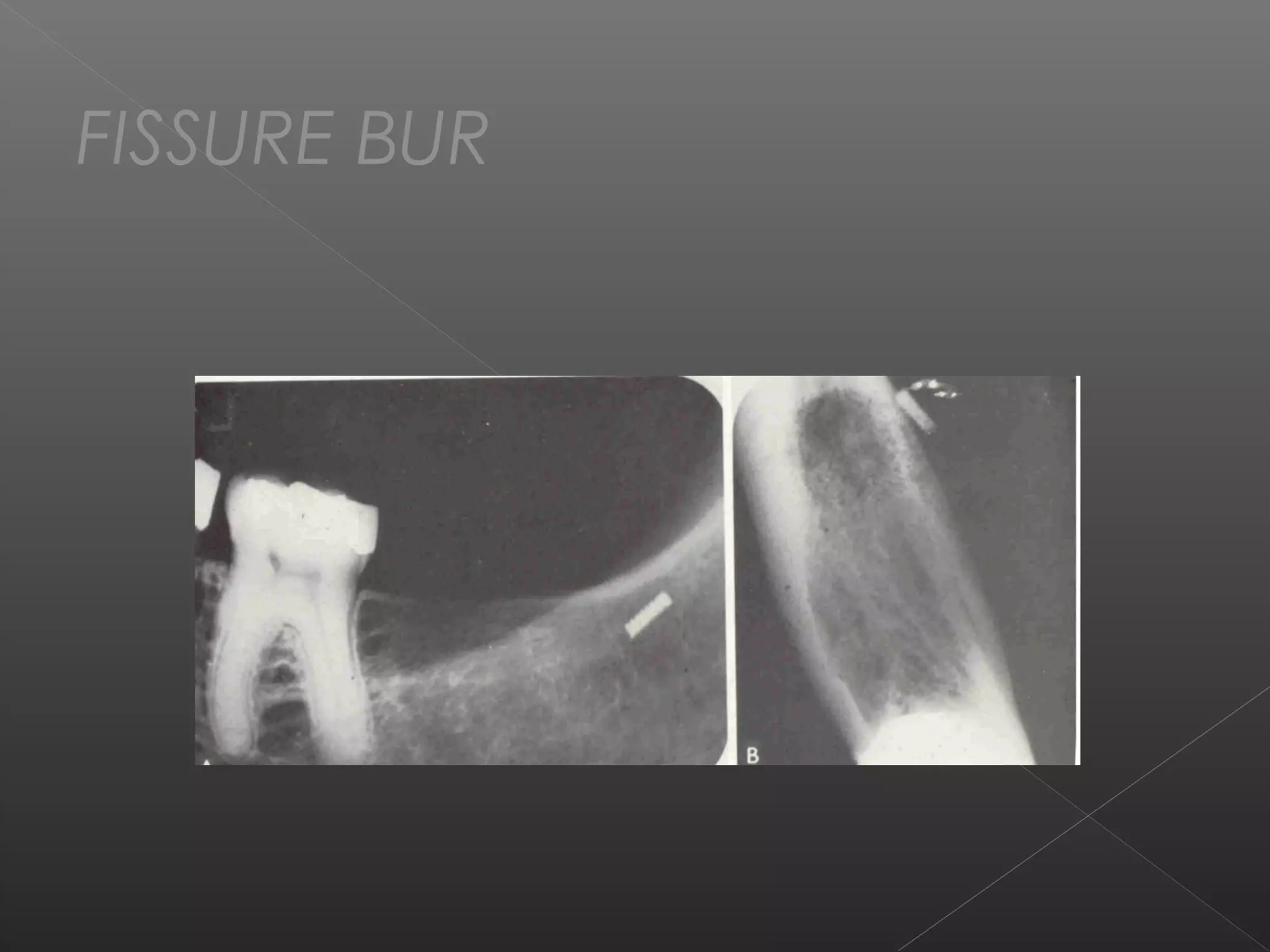 FISSURE BUR 
 