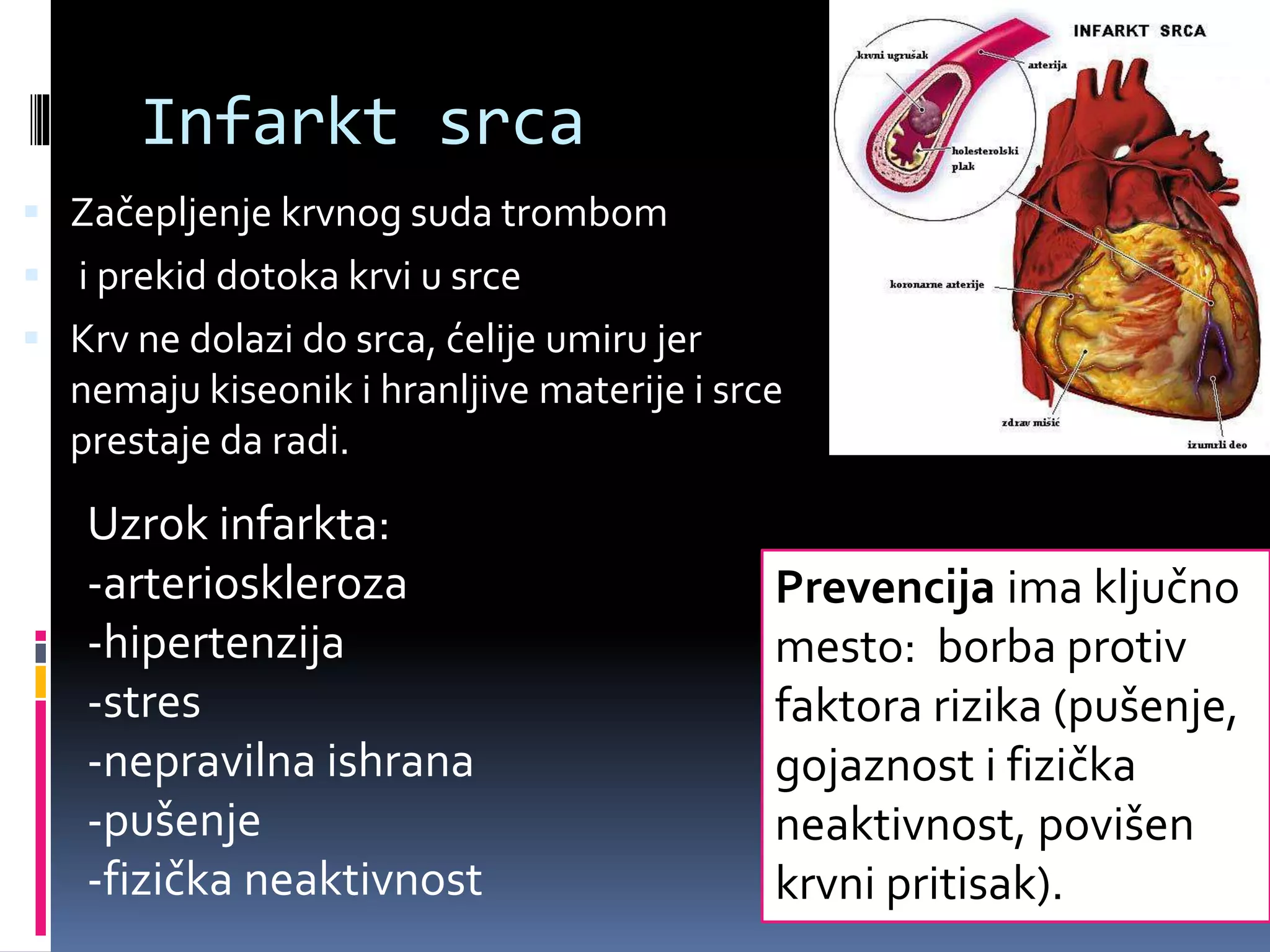 Infarkt srca
 Začepljenje krvnog suda trombom
 i prekid dotoka krvi u srce
 Krv ne dolazi do srca, ćelije umiru jer
nemaju kiseonik i hranljive materije i srce
prestaje da radi.
Prevencija ima ključno
mesto: borba protiv
faktora rizika (pušenje,
gojaznost i fizička
neaktivnost, povišen
krvni pritisak).
Uzrok infarkta:
-arterioskleroza
-hipertenzija
-stres
-nepravilna ishrana
-pušenje
-fizička neaktivnost
 