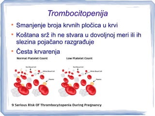 Trombocitopenija

Smanjenje broja krvnih pločica u krvi

Koštana srž ih ne stvara u dovoljnoj meri ili ih
slezina pojačano razgrađuje

Česta krvarenja
 