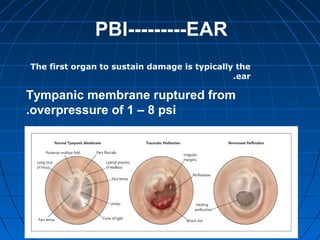 PBI---------EAR
Tympanic membrane ruptured from
overpressure of 1 – 8 psi.
The first organ to sustain damage is typically the
ear.
 