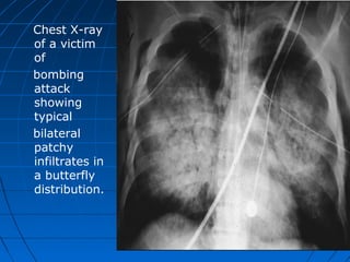 Chest X-ray
of a victim
of
bombing
attack
showing
typical
bilateral
patchy
infiltrates in
a butterfly
distribution.
 