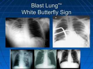 ““Blast Lung”Blast Lung”
White Butterfly SignWhite Butterfly Sign
 