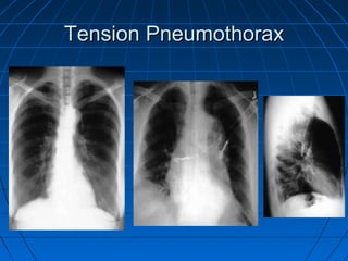 Tension PneumothoraxTension Pneumothorax
 
