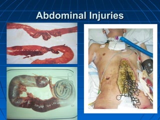Abdominal InjuriesAbdominal Injuries
 