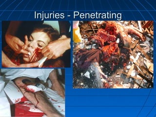 Injuries - PenetratingInjuries - Penetrating
 