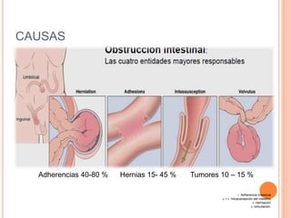 CAUSAS
Adherencias 40-80 % Hernias 15- 45 % Tumores 10 – 15 %
1. Adherencia intestinal
2. Y 3. Intususcepción del intestino
4. Herniación
5. volvulación:
 