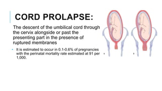 CORD PROLAPSE:
The descent of the umbilical cord through
the cervix alongside or past the
presenting part in the presence of
ruptured membranes
• It is estimated to occur in 0.1-0.6% of pregnancies
with the perinatal mortality rate estimated at 91 per
1,000.
 