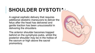 SHOULDER DYSTOTIA:
A vaginal cephalic delivery that requires
additional obstetric maneuvers to deliver the
fetus after the head has delivered and
gentle traction has been unsuccessful in
delivering the shoulders
The anterior shoulder becomes trapped
behind on the symphysis pubis, whilst the
posterior shoulder may be in the hollow of
the sacrum or high above the sacral
promontory.
 