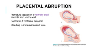 PLACENTAL ABRUPTION
Premature separation of normally sited
placenta from uterine wall.
Poor fetal & maternal outcome
Bleeding is maternal or/and fetal.
 
