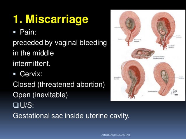 sma syndrome