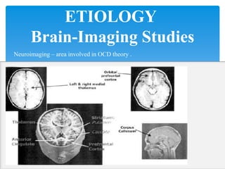 ETIOLOGY
Brain-Imaging Studies
Neuroimaging – area involved in OCD theory .
 