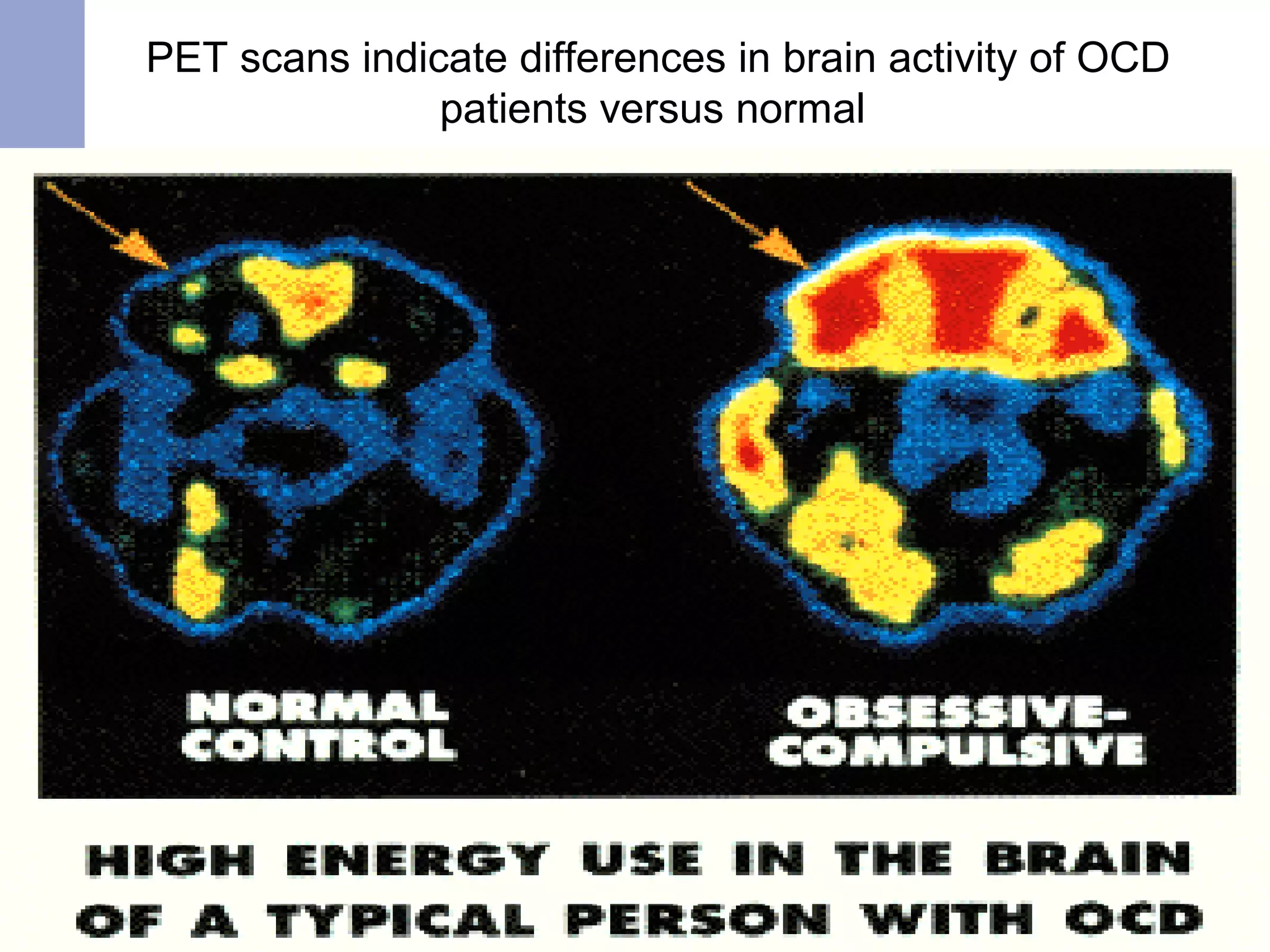 PET scans indicate differences in brain activity of OCD
patients versus normal
 