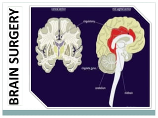 BRAINSURGERY
 