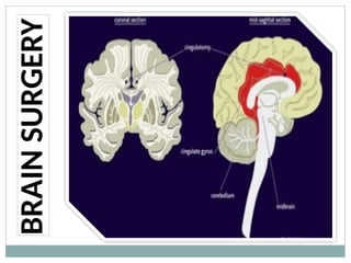 BRAIN
SURGERY
 