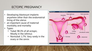 ECTOPIC PREGNANCY
• Developing blastocyst implants
anywhere other than the endometrial
lining of the uterus
• an important cause of maternal
morbidity and mortality
• Types:
• Tubal: 98.3% of all ectopic.
Mostly in the isthmus
• Nontubal: 1.7%. Very rarely in the
ovary or the cervix
 