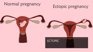 ECTOPIC
 