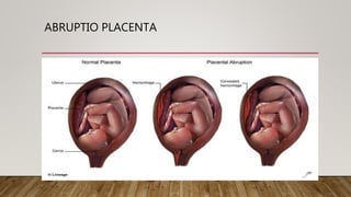 ABRUPTIO PLACENTA
 