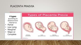 PLACENTA PRAEVIA
4 types
according to
distance from
internal os
• Partial
• Low Lying
• Marginal
• Major or
Complete
 