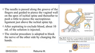 AMBO University School/college name here
oThe needle is passed along the groove of the
fingers and guided to pierce the vaginal wall
on the apex of ischial spine and thereafter to
push a little to pierce the sacrospinous
ligament just above the ischial spine tip.
oAfter aspirating to exclude blood, about 10
mL of the solution is injected.
oThe similar procedure is adopted to block
the nerve of the other side by changing the
hands.
09/02/2024 Rebuma M. 33
 