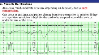 AMBO University School/college name here
iii. Variable Decelerations
Abnormal (mild, moderate or severe depending on duration), due to cord
compression.
Can occur at any time, and pattern change from one contraction to another. If they
are repetitive, suspicion is high for the cord to be wrapped around the neck or
under the arm of the fetus.
09/02/2024 Rebuma M. 91
 