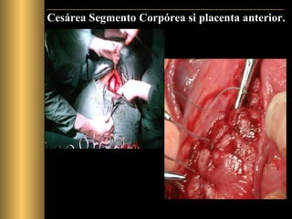 Cesárea Segmento Corpórea si placenta anterior. 