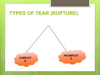 TYPES OF TEAR (RUPTURE)
COMPLET
E
INCOMPLET
E
 