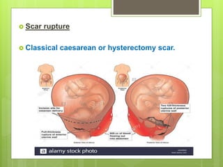  Scar rupture
 Classical caesarean or hysterectomy scar.
 