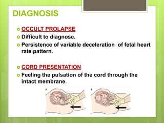 DIAGNOSIS
 OCCULT PROLAPSE
 Difficult to diagnose.
 Persistence of variable deceleration of fetal heart
rate pattern.
 CORD PRESENTATION
 Feeling the pulsation of the cord through the
intact membrane.
 