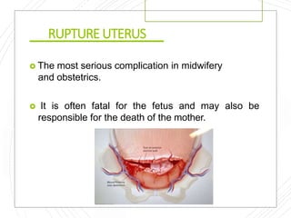 RUPTUREUTERUS
 The most serious complication in midwifery
and obstetrics.
 It is often fatal for the fetus and may also be
responsible for the death of the mother.
 
