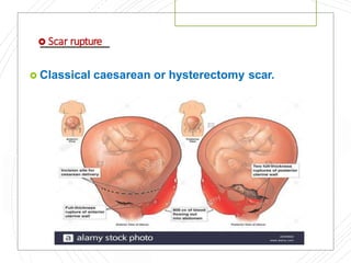  Scar rupture
 Classical caesarean or hysterectomy scar.
 