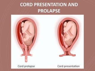 CORD PRESENTATION AND
PROLAPSE
 