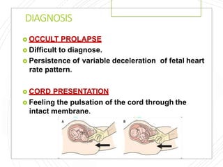 DIAGNOSIS
 OCCULT PROLAPSE
 Difficult to diagnose.
 Persistence of variable deceleration of fetal heart
rate pattern.
 CORD PRESENTATION
 Feeling the pulsation of the cord through the
intact membrane.
 