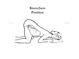 Kneechest
Position
 