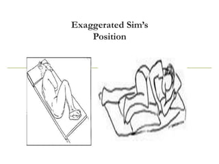 Exaggerated Sim’s
Position
 