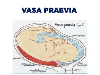 VASA PRAEVIA
 