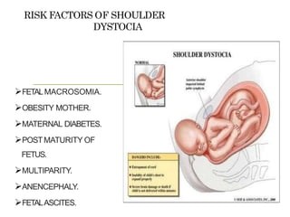 RISK FACTORS OF SHOULDER
DYSTOCIA
FETALMACROSOMIA.
OBESITY MOTHER.
MATERNAL DIABETES.
POSTMATURITY OF
FETUS.
MULTIPARITY.
ANENCEPHALY.
FETALASCITES.
 