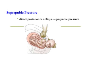 Suprapubic Pressure
• direct posterior or oblique suprapubic pressure
 